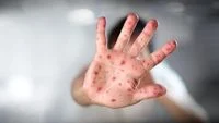 Measles: Understanding the Symptoms and Risks in Adults