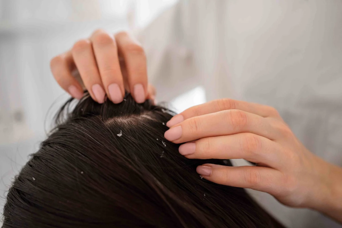 Understanding Dry Dandruff: Causes, Symptoms, and Effective Solutions for a Healthier Scalp