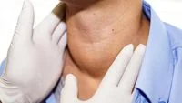 Recognizing the Subtle Signs: Understanding Goiter, Its Causes, and Risk Factors